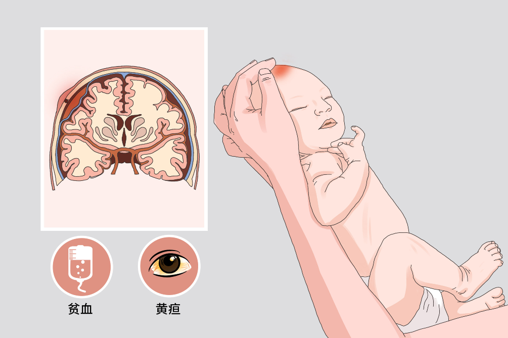 新生儿头颅血肿