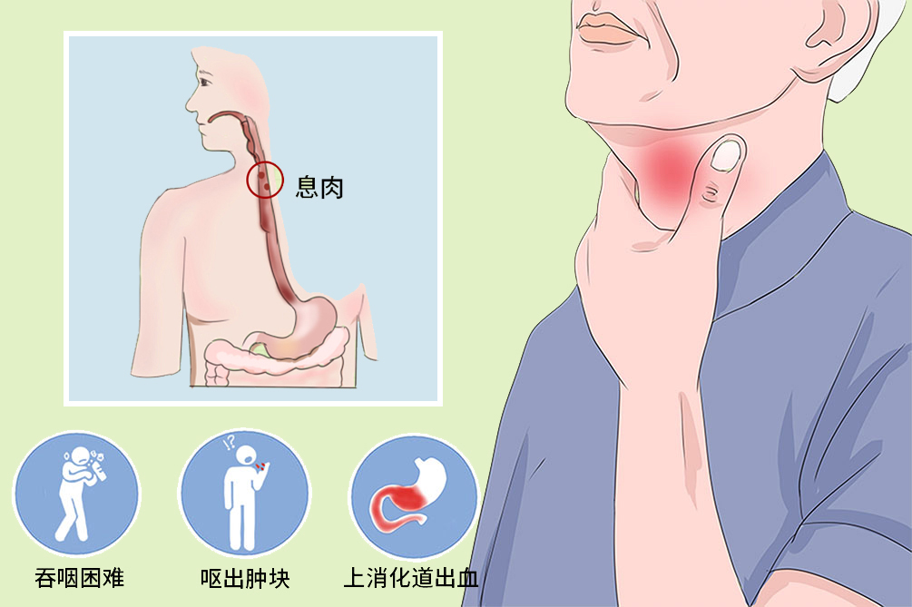 食管息肉