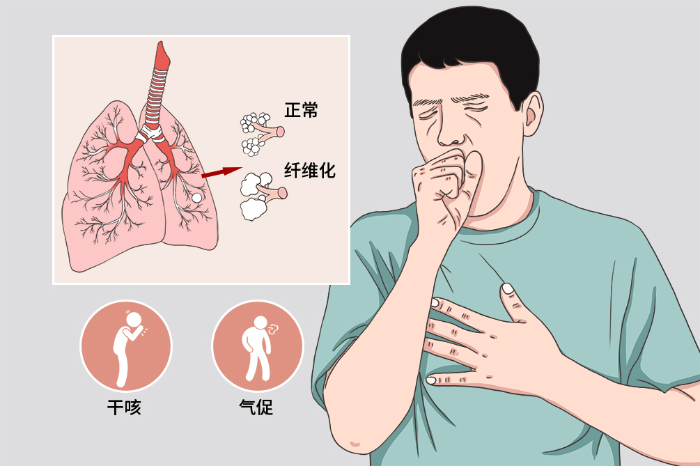 间质性肺疾病