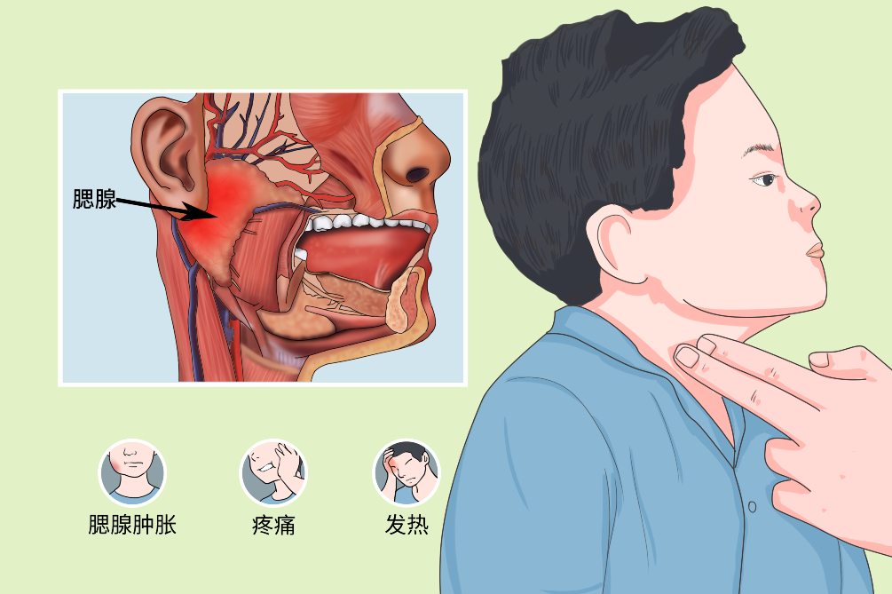 流行性腮腺炎