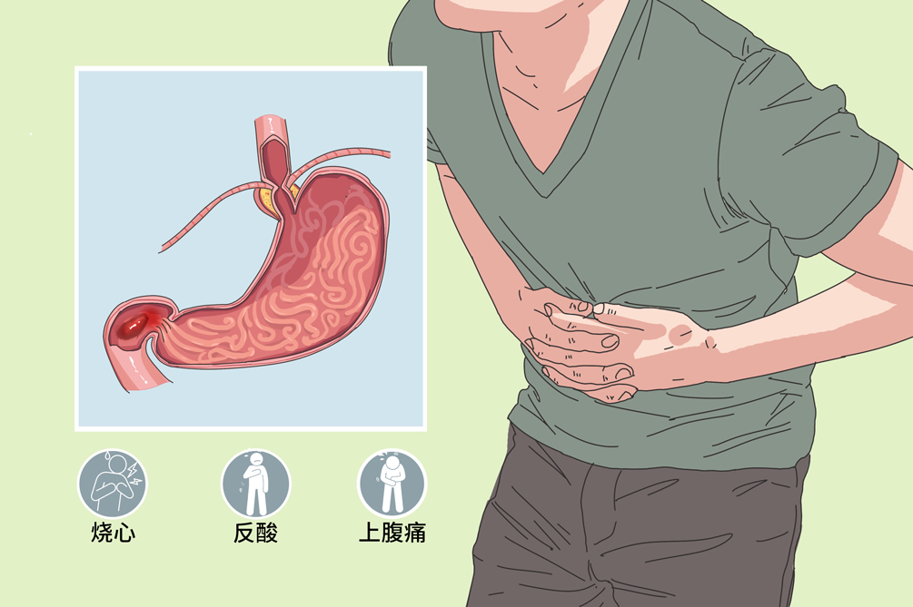 十二指肠球部溃疡