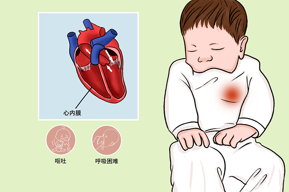 小儿心内膜弹力纤维增生症