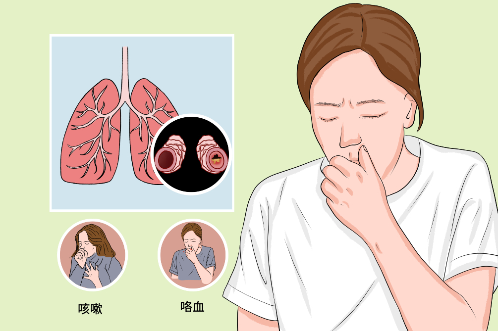 支气管扩张