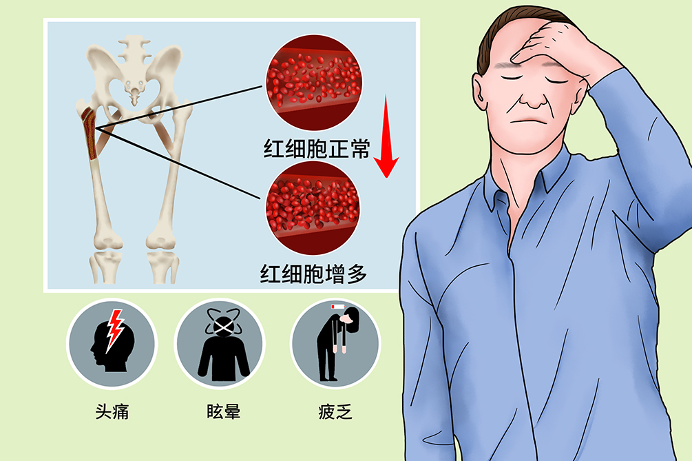 真性红细胞增多症