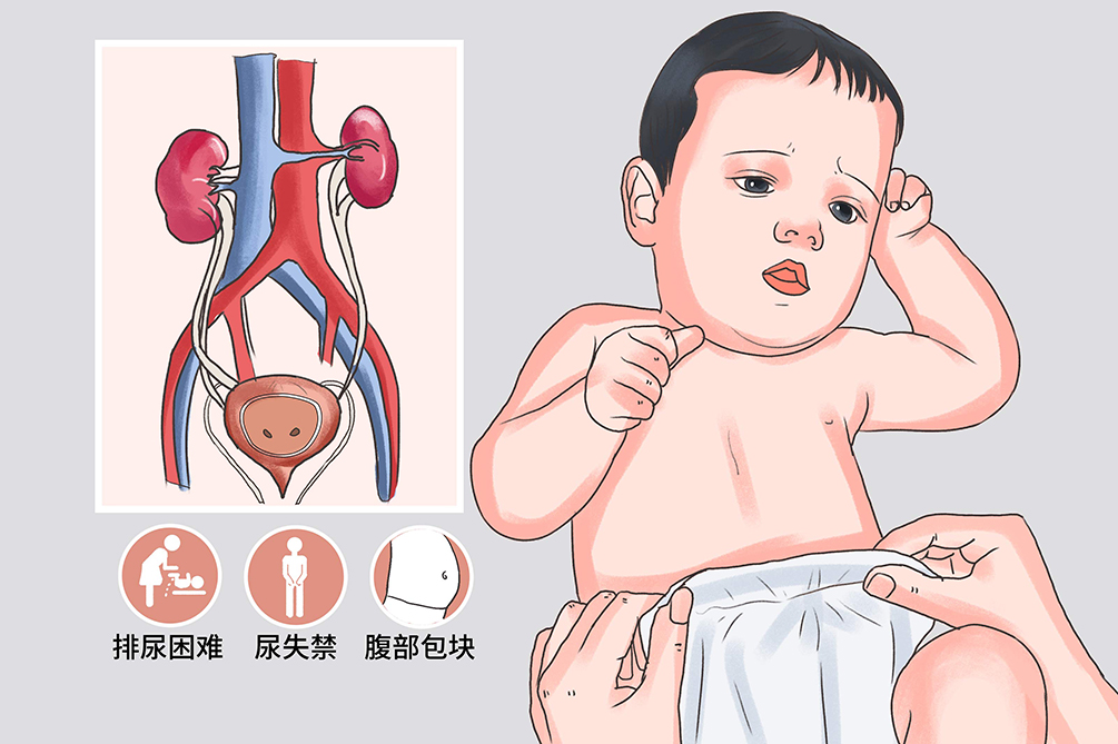 先天性泌尿系畸形