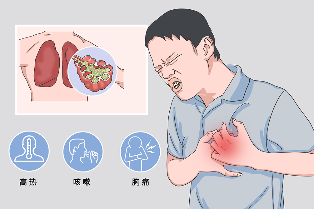 大叶性肺炎