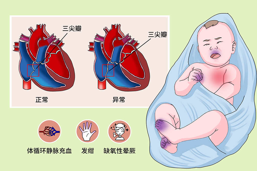 三尖瓣闭锁