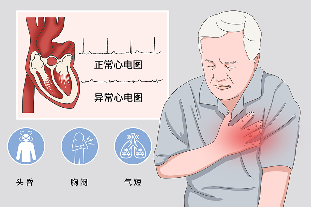 窦性心动过缓