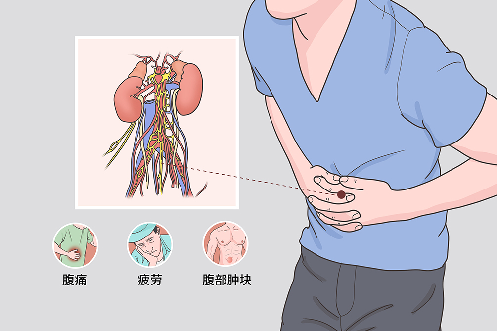 腹膜后纤维化