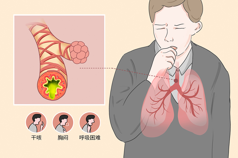 咳嗽变异性哮喘