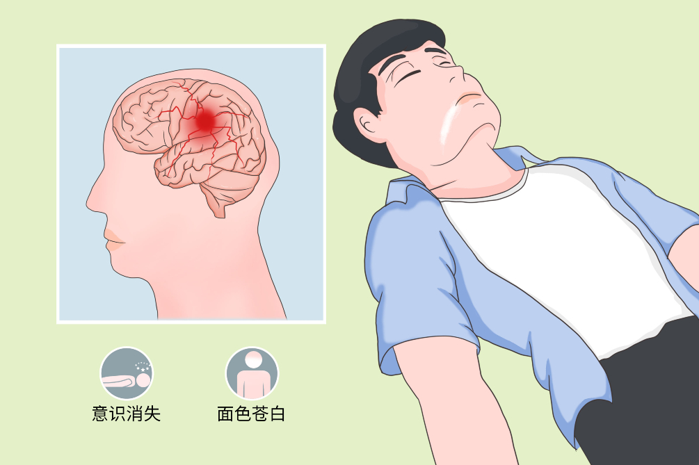 外伤性癫痫