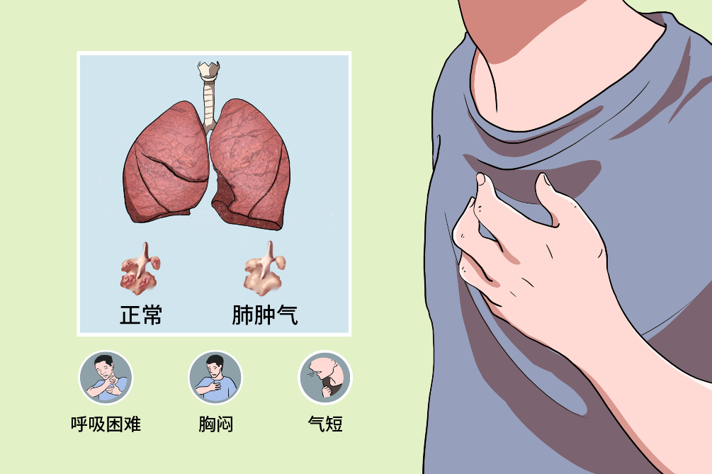 阻塞性肺气肿