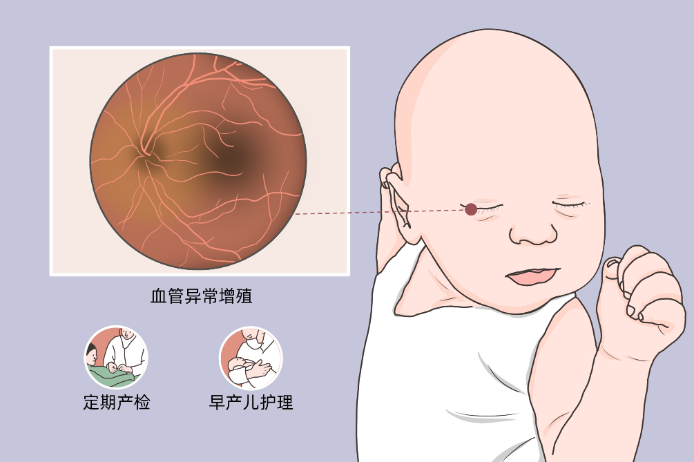 早产儿视网膜病变