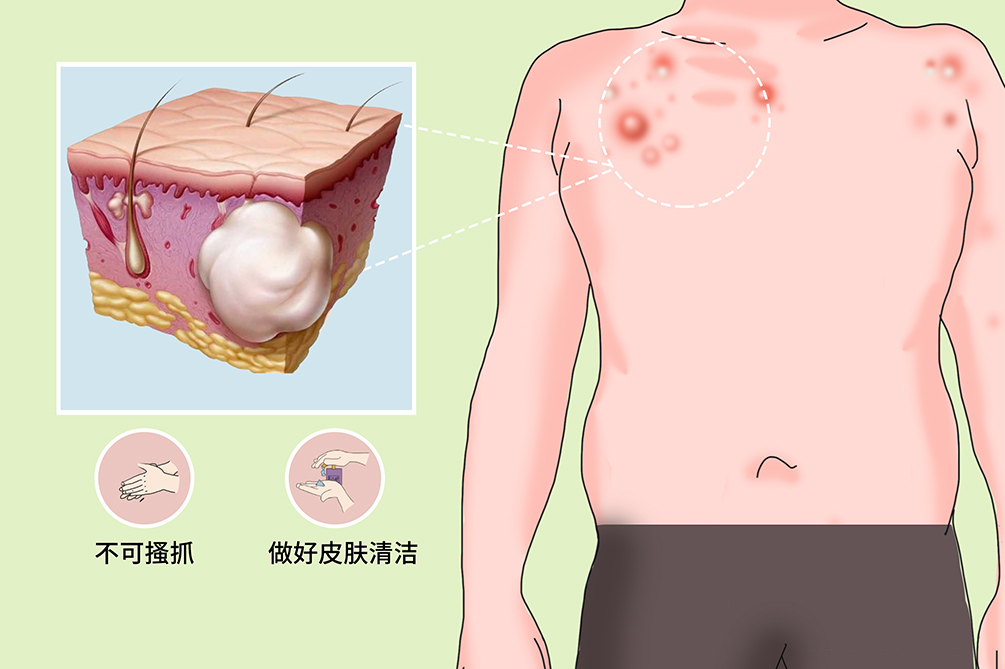 皮脂腺囊肿