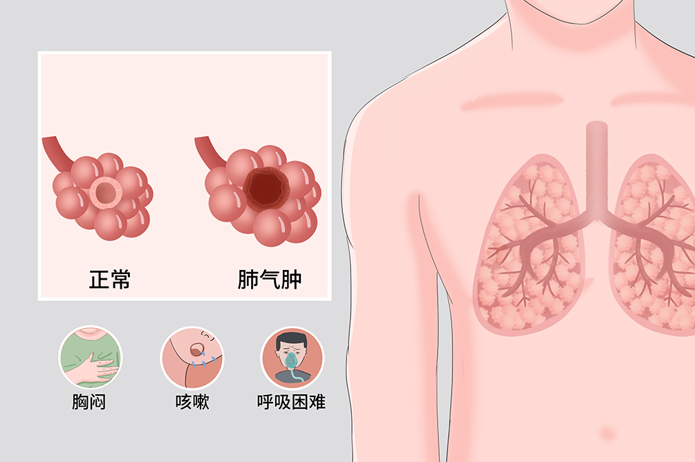 肺气肿