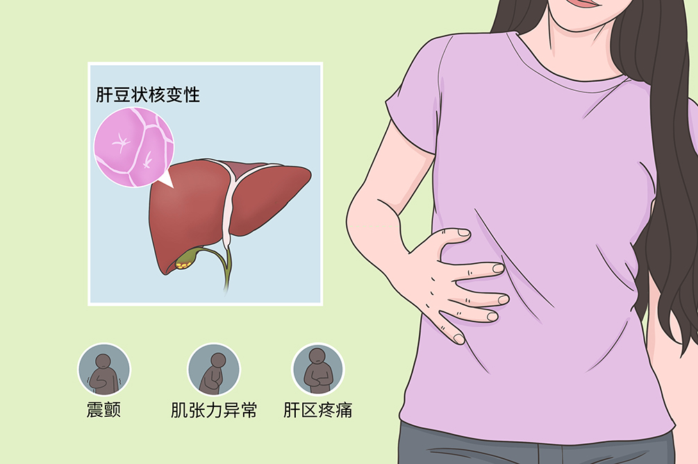 肝豆状核变性