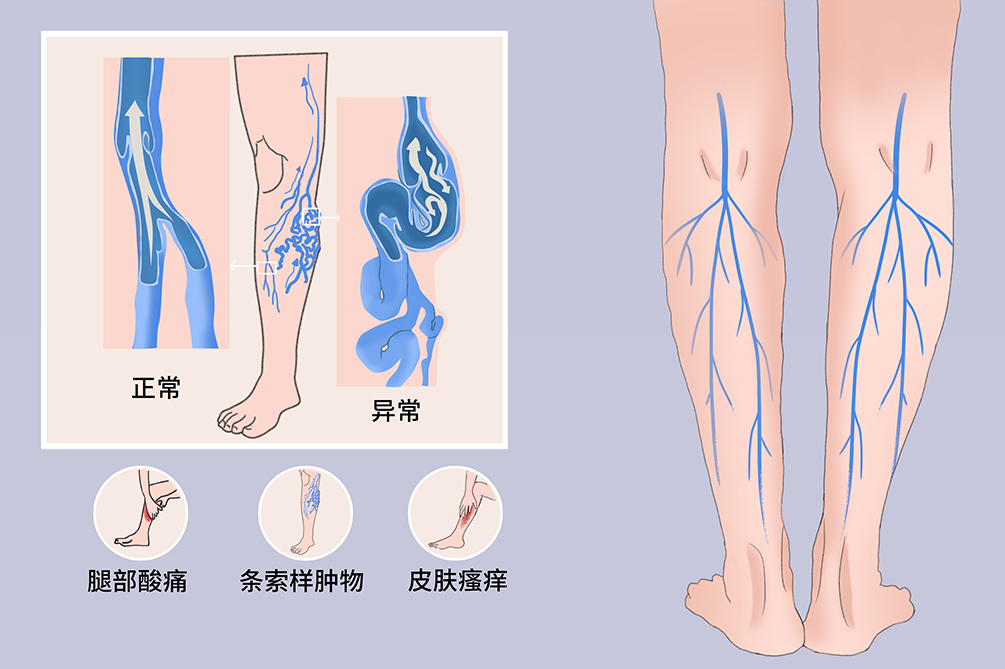 单纯性下肢静脉曲张