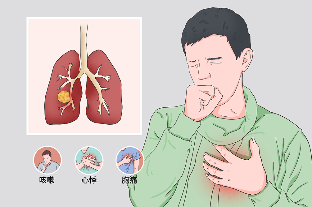 放射性肺炎