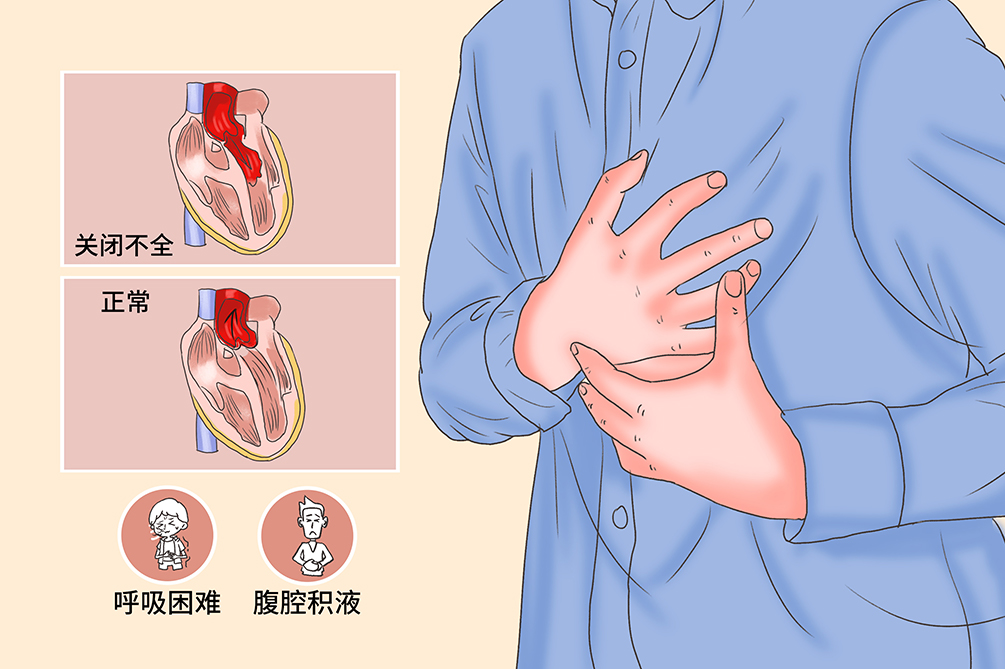 二尖瓣关闭不全