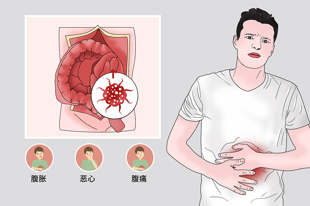 腹膜后肿瘤