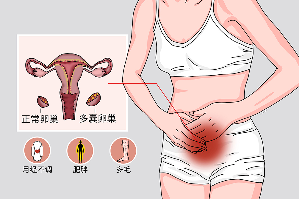 多囊卵巢综合征
