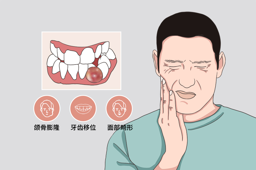 颌骨囊肿