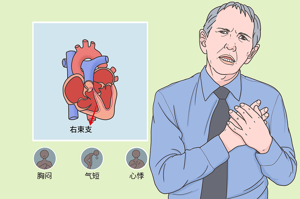 右束支传导阻滞