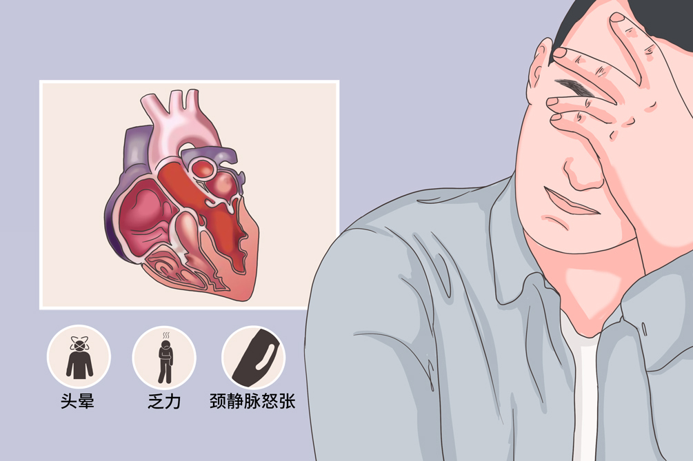 限制型心肌病