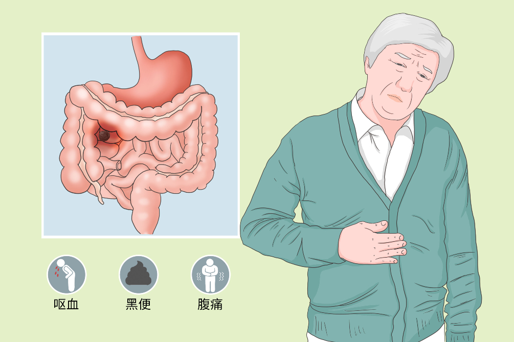 胃肠道间质瘤