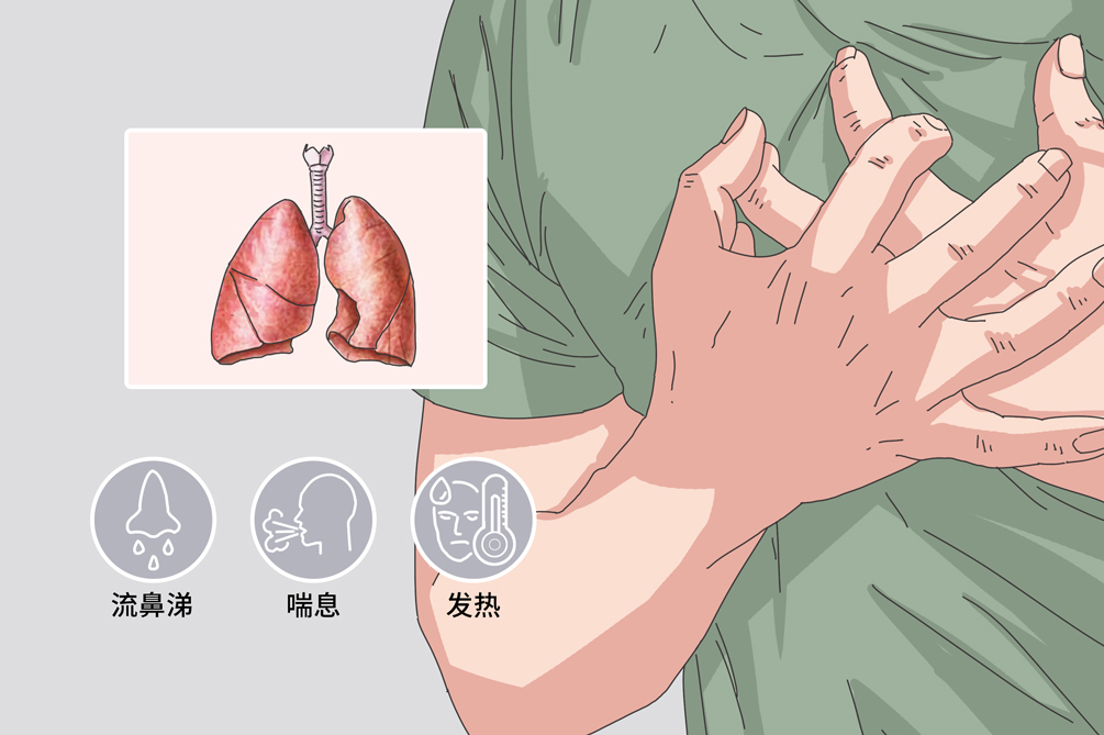 过敏性肺炎