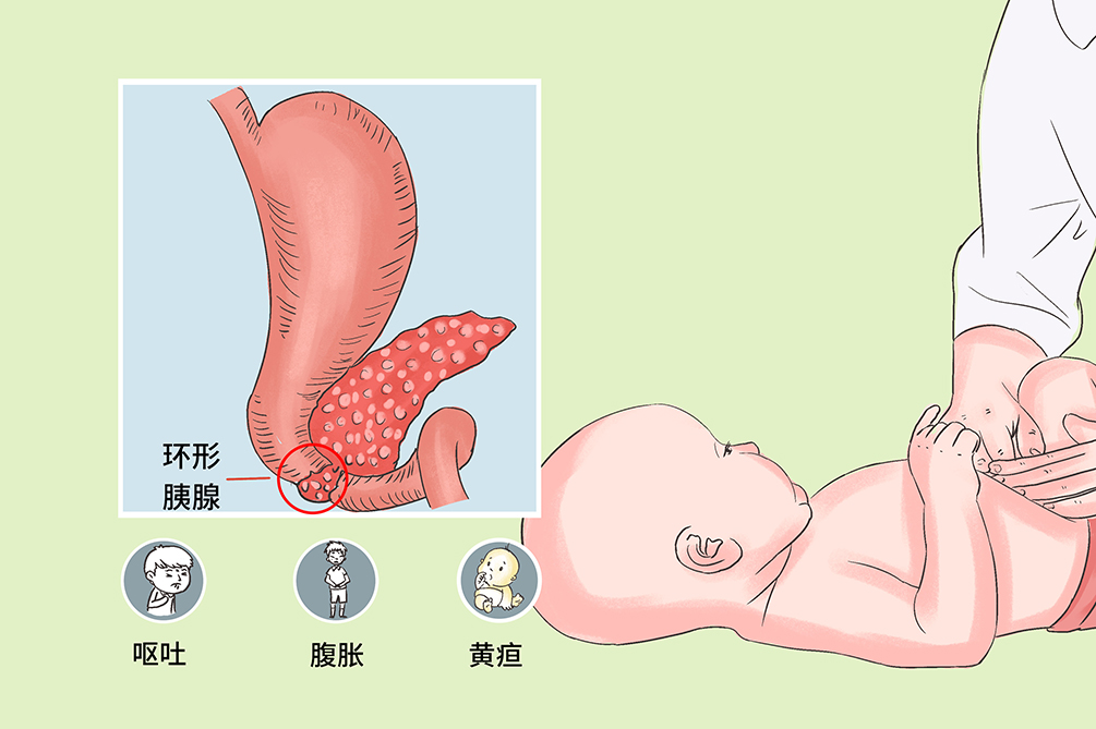 环形胰腺