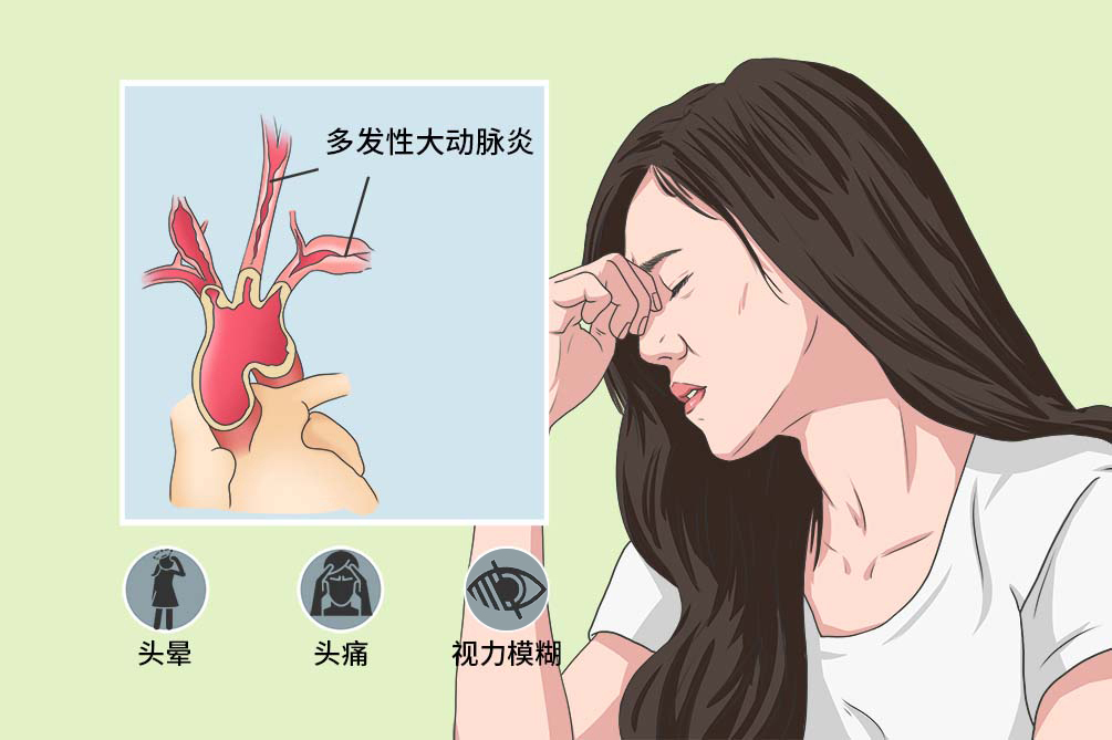 多发性大动脉炎