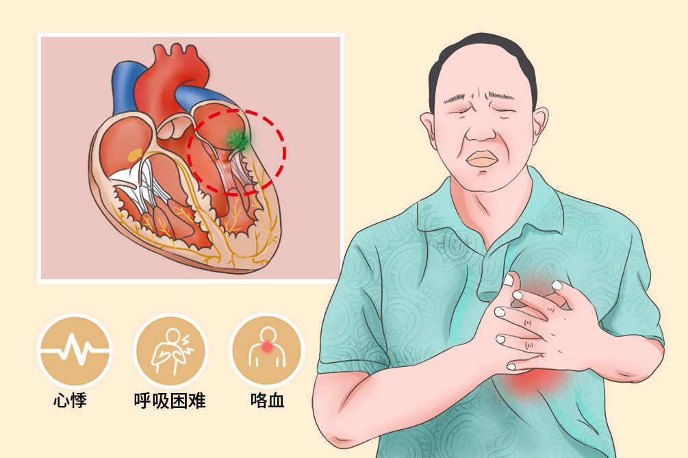 风湿性心脏病