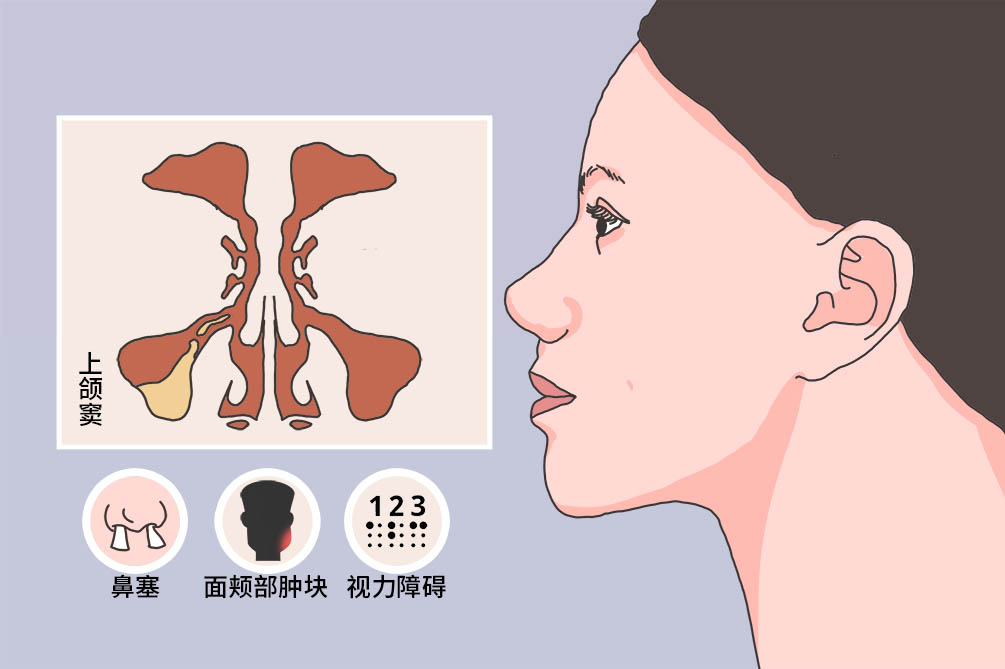 上颌窦牙源性囊肿