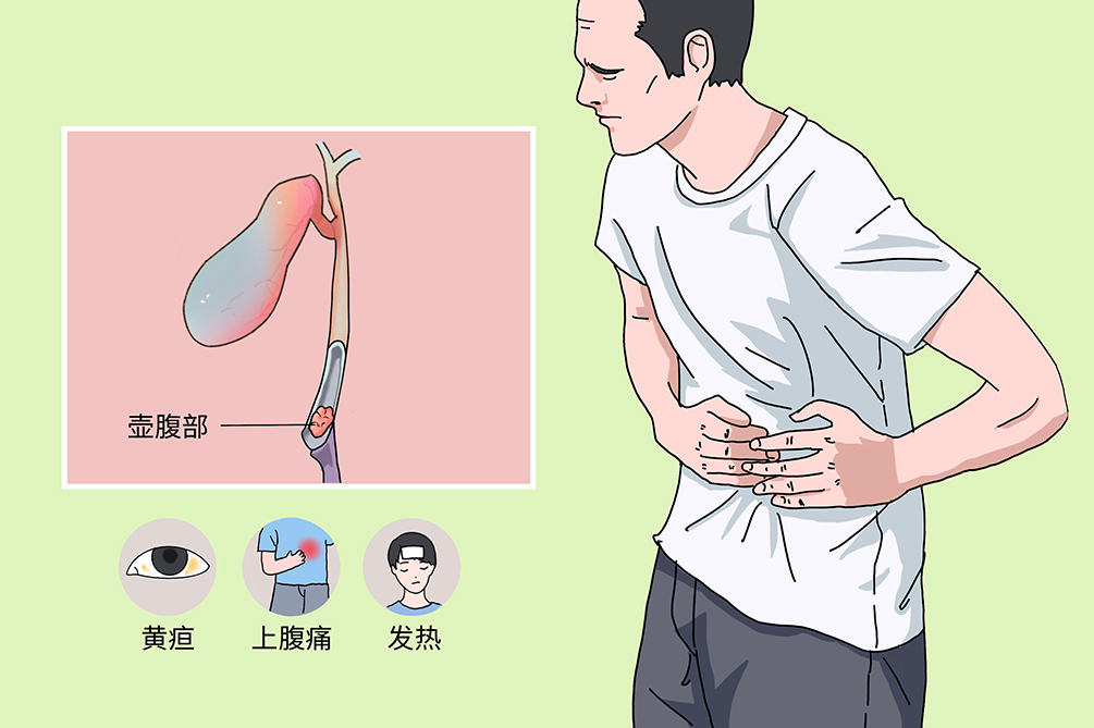 壶腹周围癌