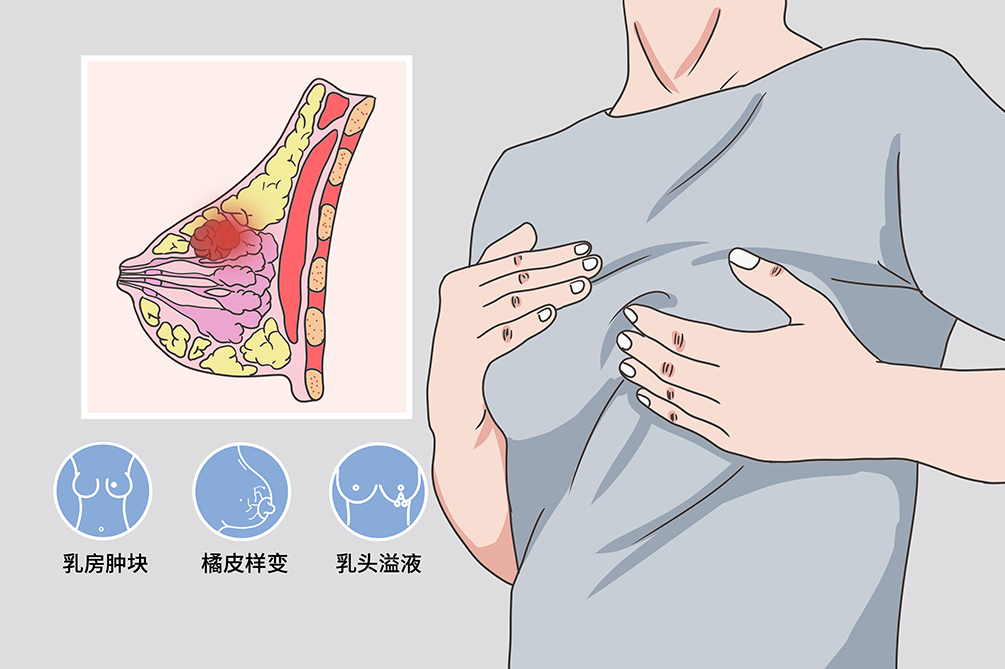 乳腺癌