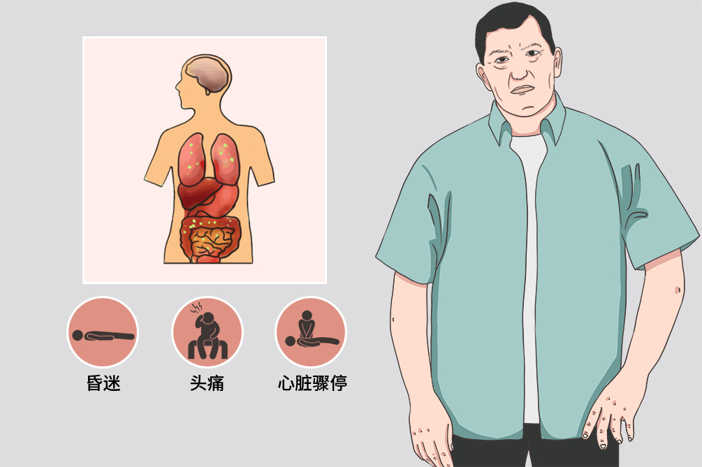 神经内分泌肿瘤