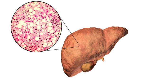 脂肪肝有什么原因引起的 分析各类型脂肪肝形成的原因