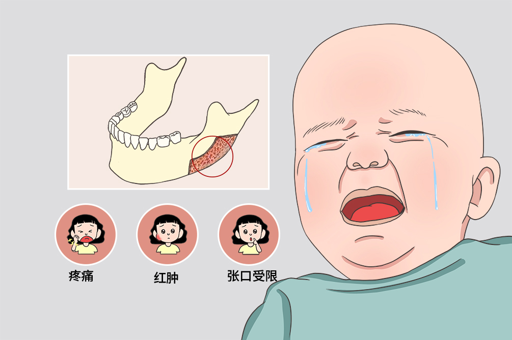 颌骨骨髓炎