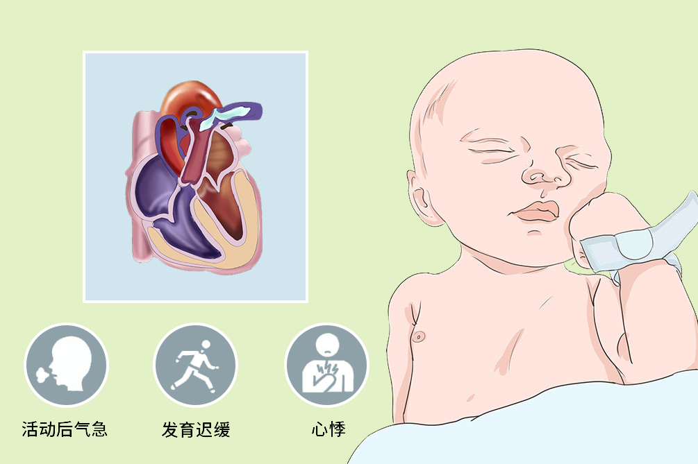 动脉导管未闭