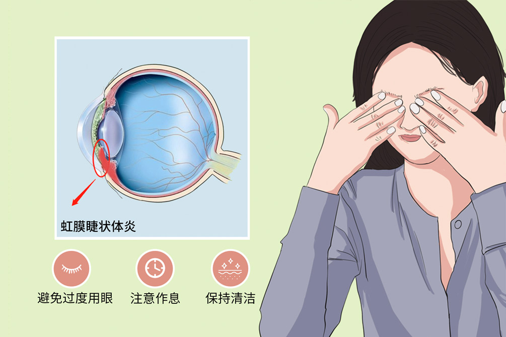 虹膜睫状体炎