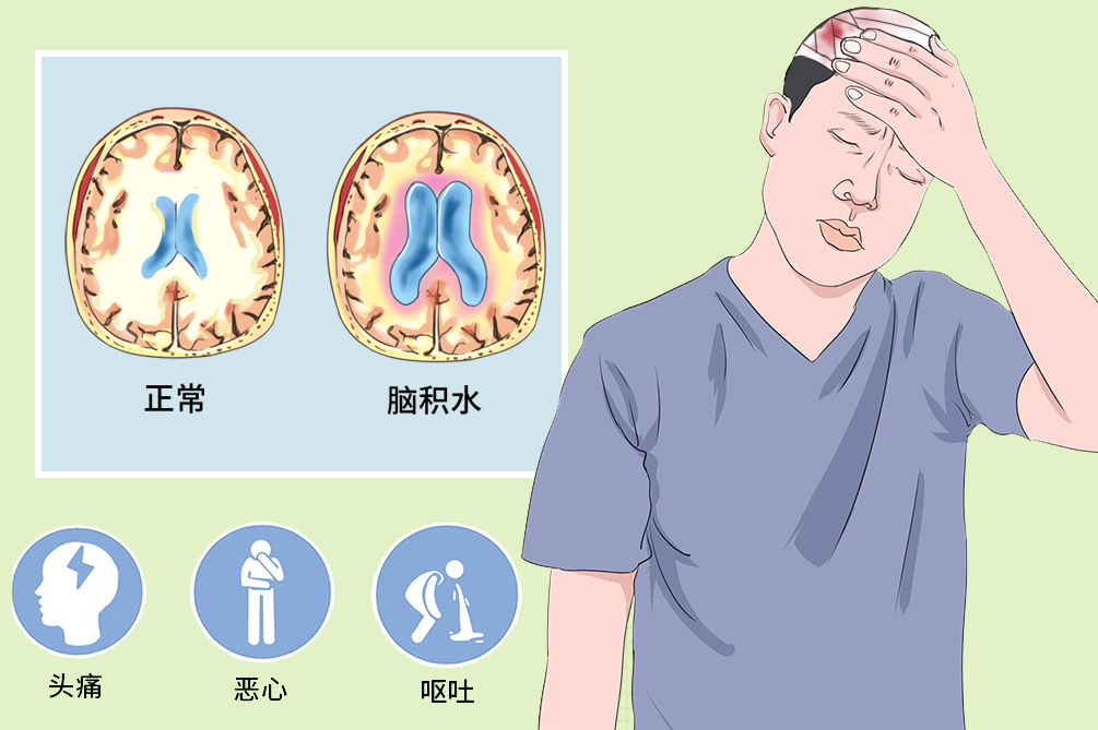 外伤性脑积水