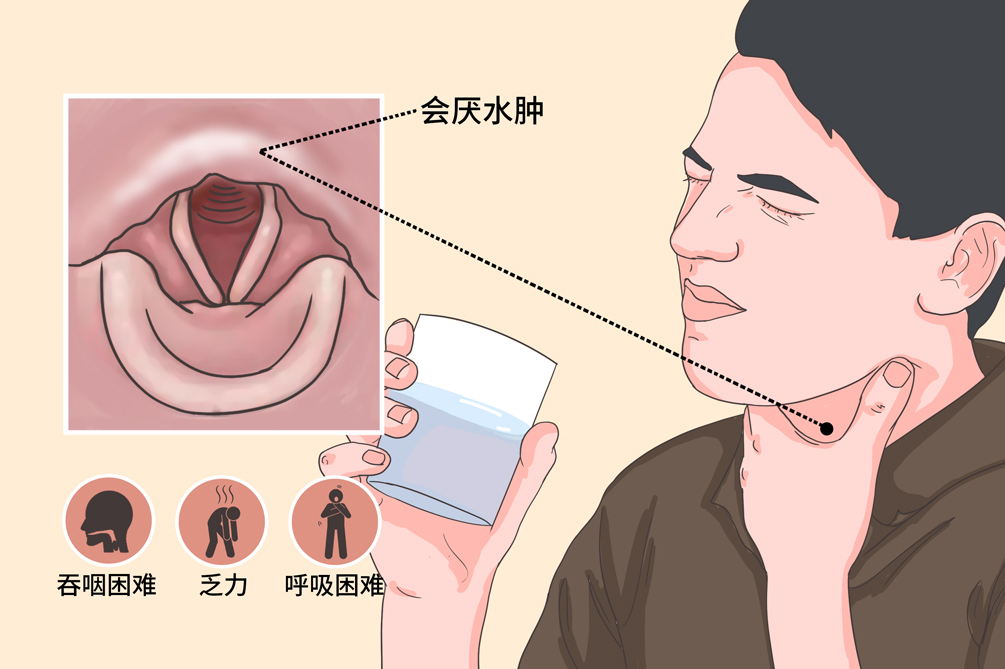 急性会厌炎