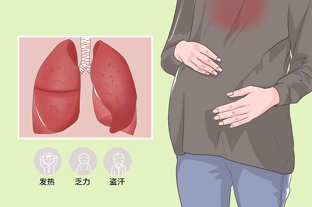 妊娠合并肺结核