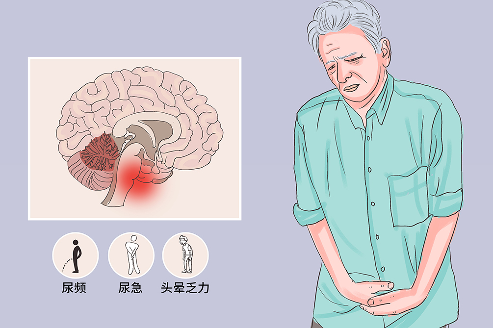 多系统萎缩