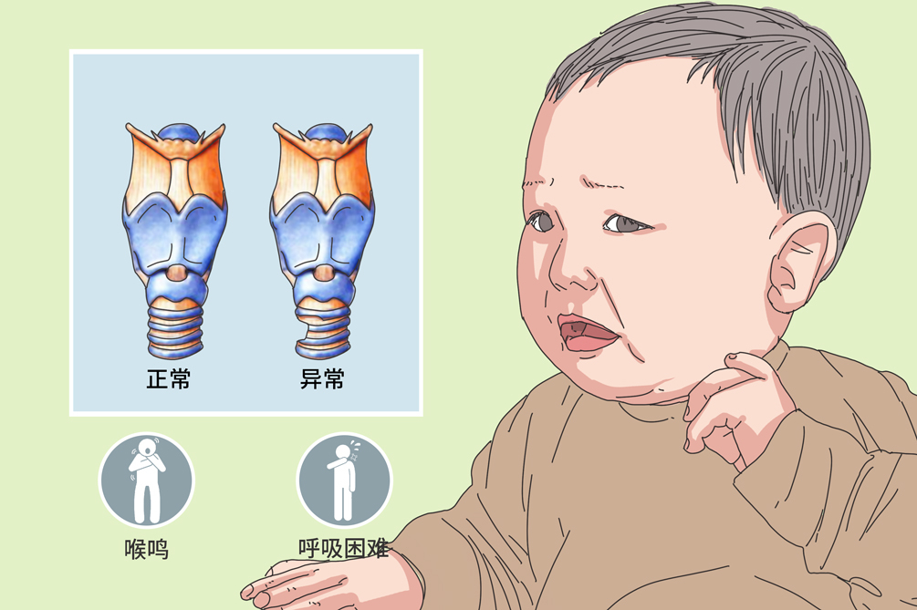 先天性喉软骨畸形