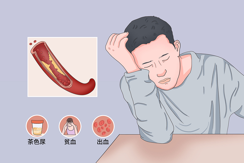 阵发性睡眠性血红蛋白尿症