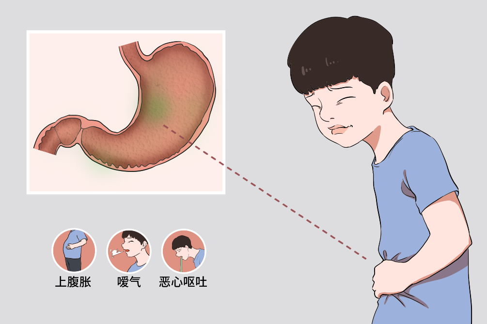 小儿功能性消化不良