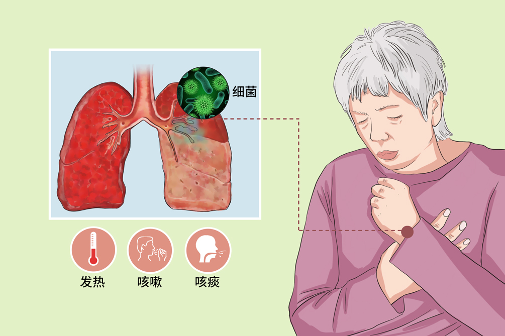 细菌性肺炎