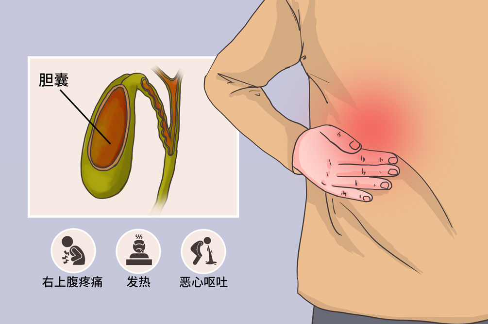 急性胆囊炎